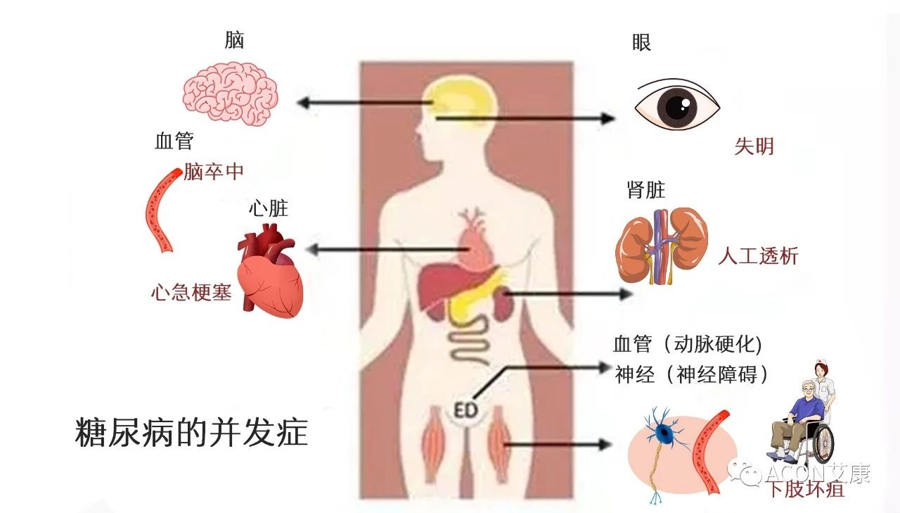爆上熱搜，因爆發(fā)型糖尿病進入ICU，有哪些教訓值得我們汲取